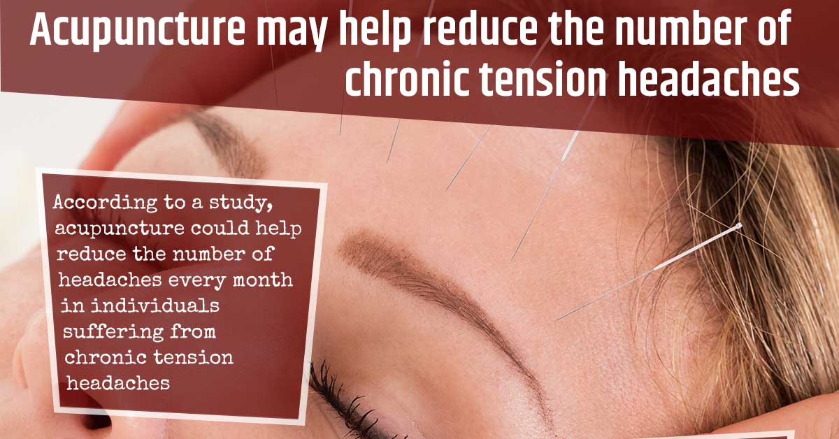 Acupuncture May Help Reduce the Number of Chronic Tension Headaches